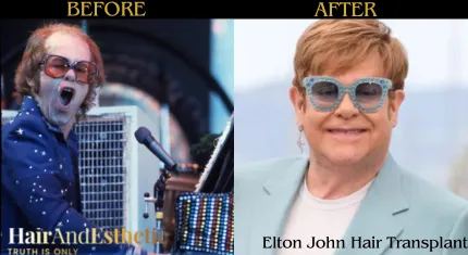 Elton-John-fue-hair-transplantation in Turkey