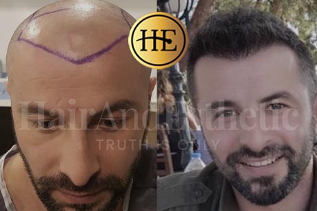 hair-transplantation in Istanbul